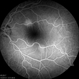 Multifocal Central Serous Chorioretinopathy OS Multifocal Central Serous Chorioretinopathy OS
